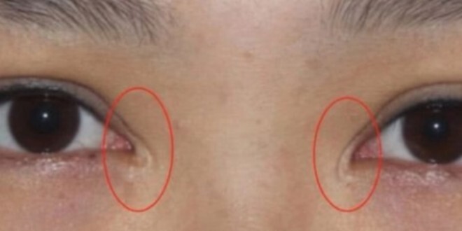 我自己当时做双眼皮的时候,,眼角那里有过凸起的疤痕,刚开始特别明显