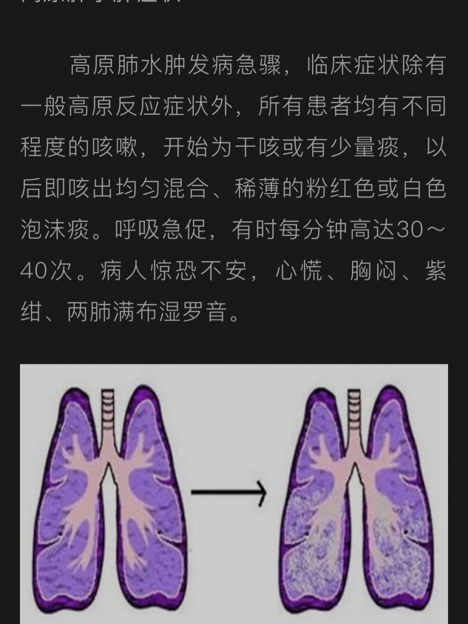 肺水肿症状图片