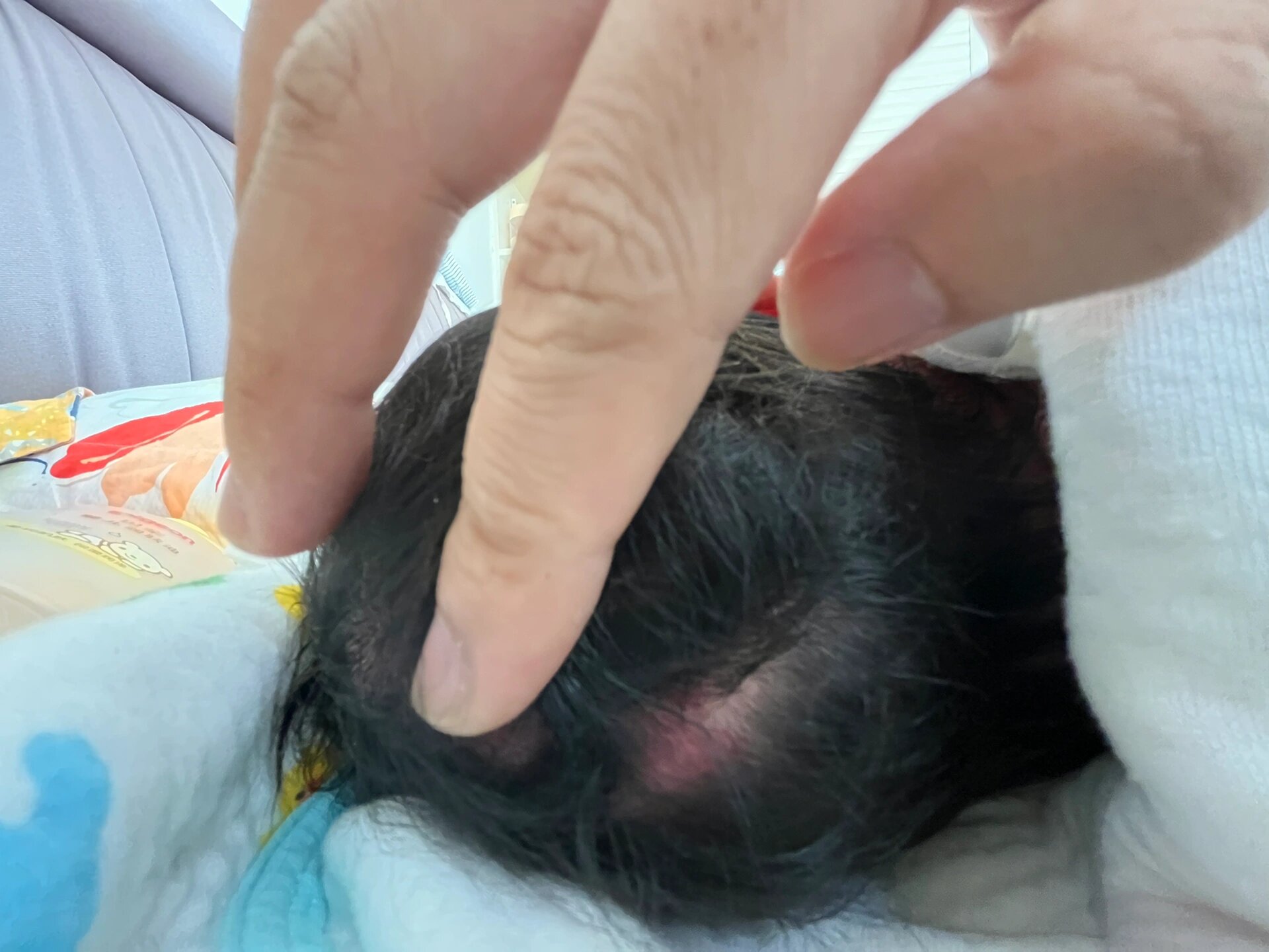 婴儿后脑勺头皮发红 今天给宝宝洗澡澡,突然发现宝宝后脑勺头皮一大块