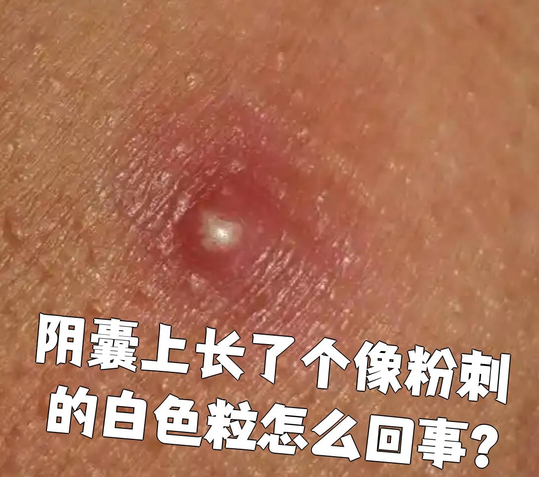 阴囊上长了个像粉刺的白色粒怎么回事?