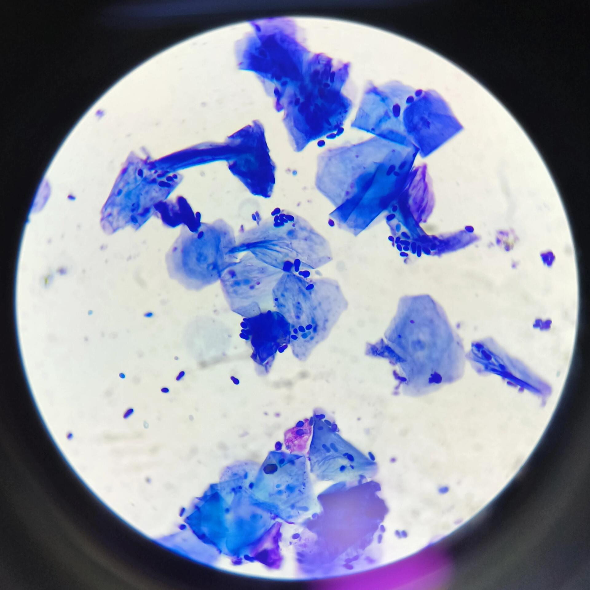 镜检〗耳道分泌物中可见马拉色菌 马拉色菌附着在耳道的鳞状上皮