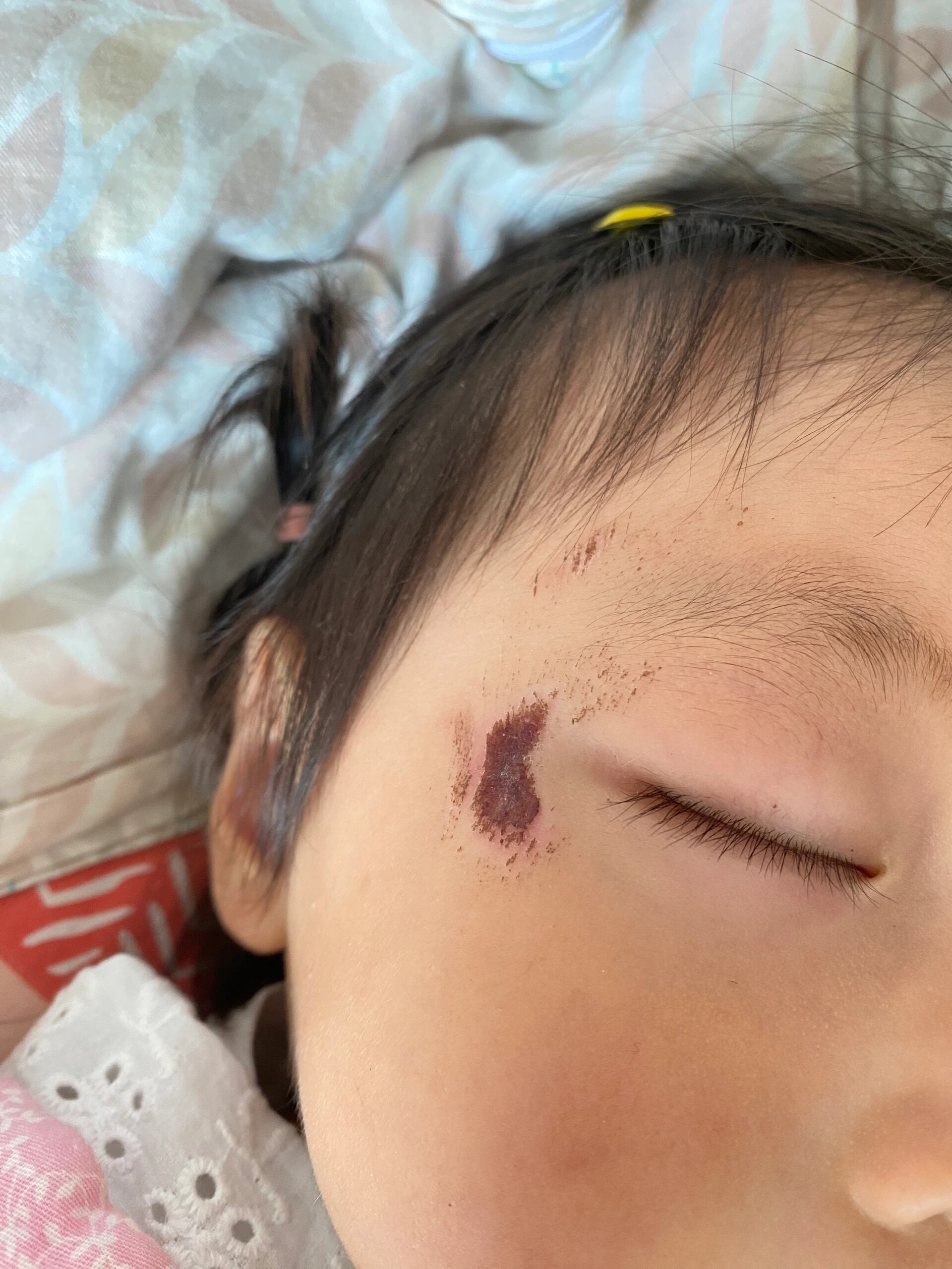 结痂后有红印怎么办啊?