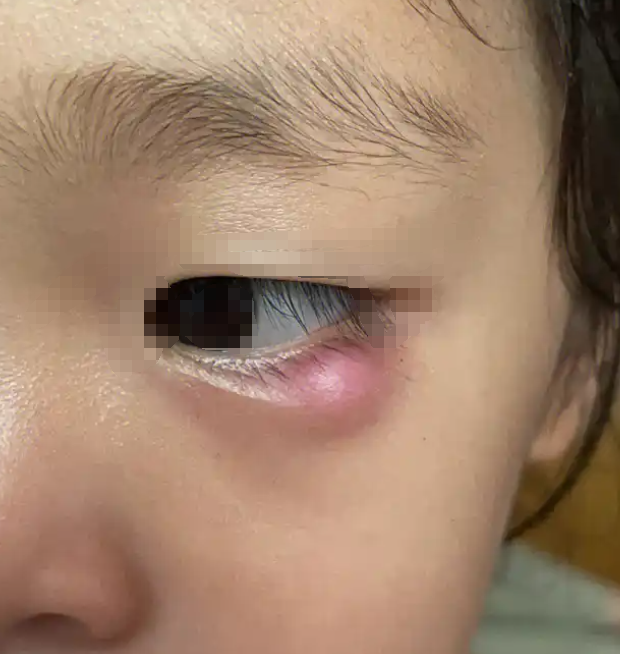 眼肿瘤没有所谓的"10大前兆",但常见症状主要包括视力问题,眼部肿块