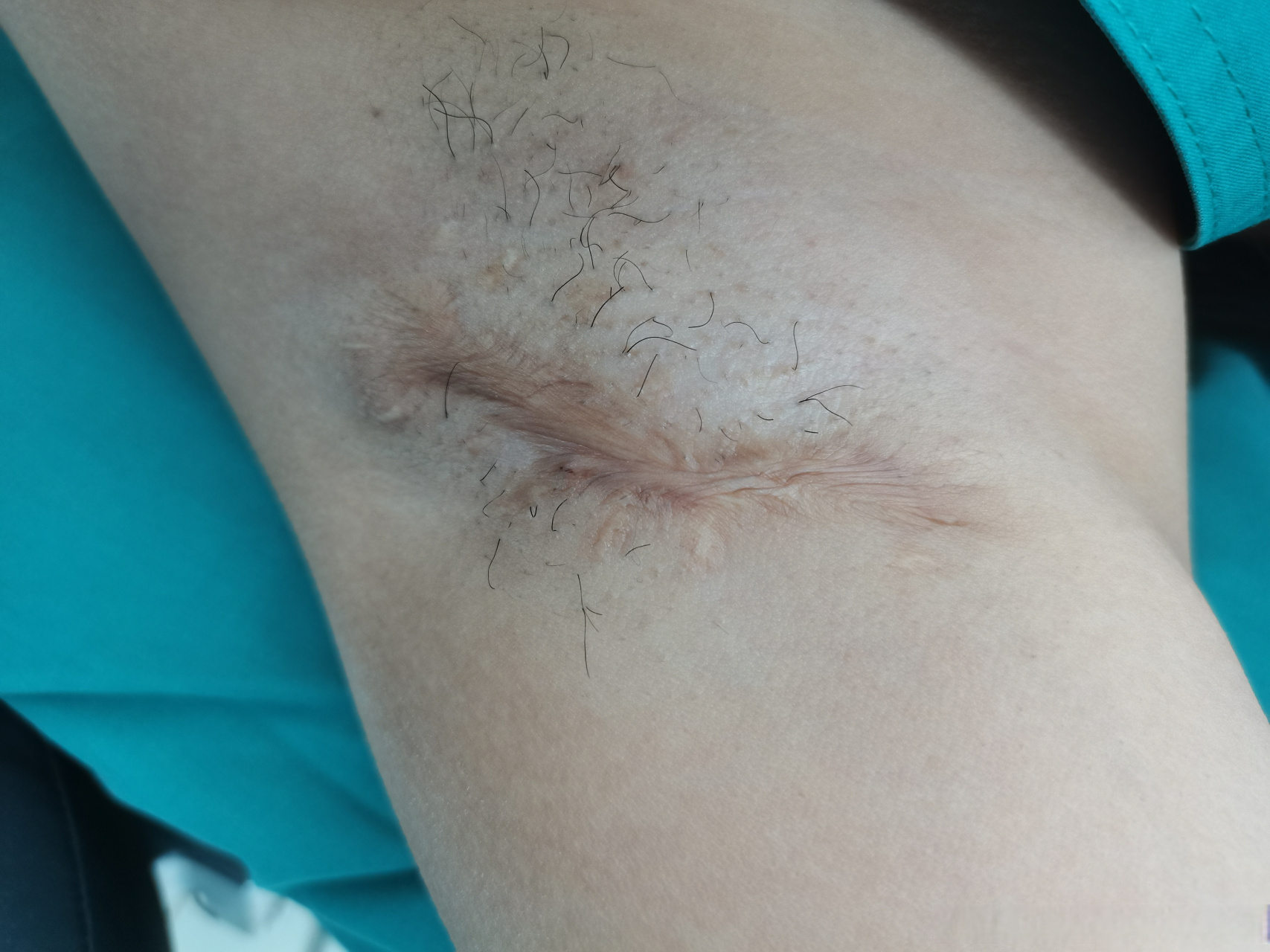 腋臭手术后留疤,这是很常见的,因为腋下一是汗腺分布密集容易滋生细菌