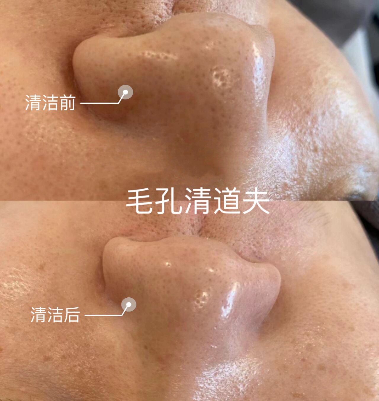 深层毛囊清洁(俗称毛孔的清道夫)