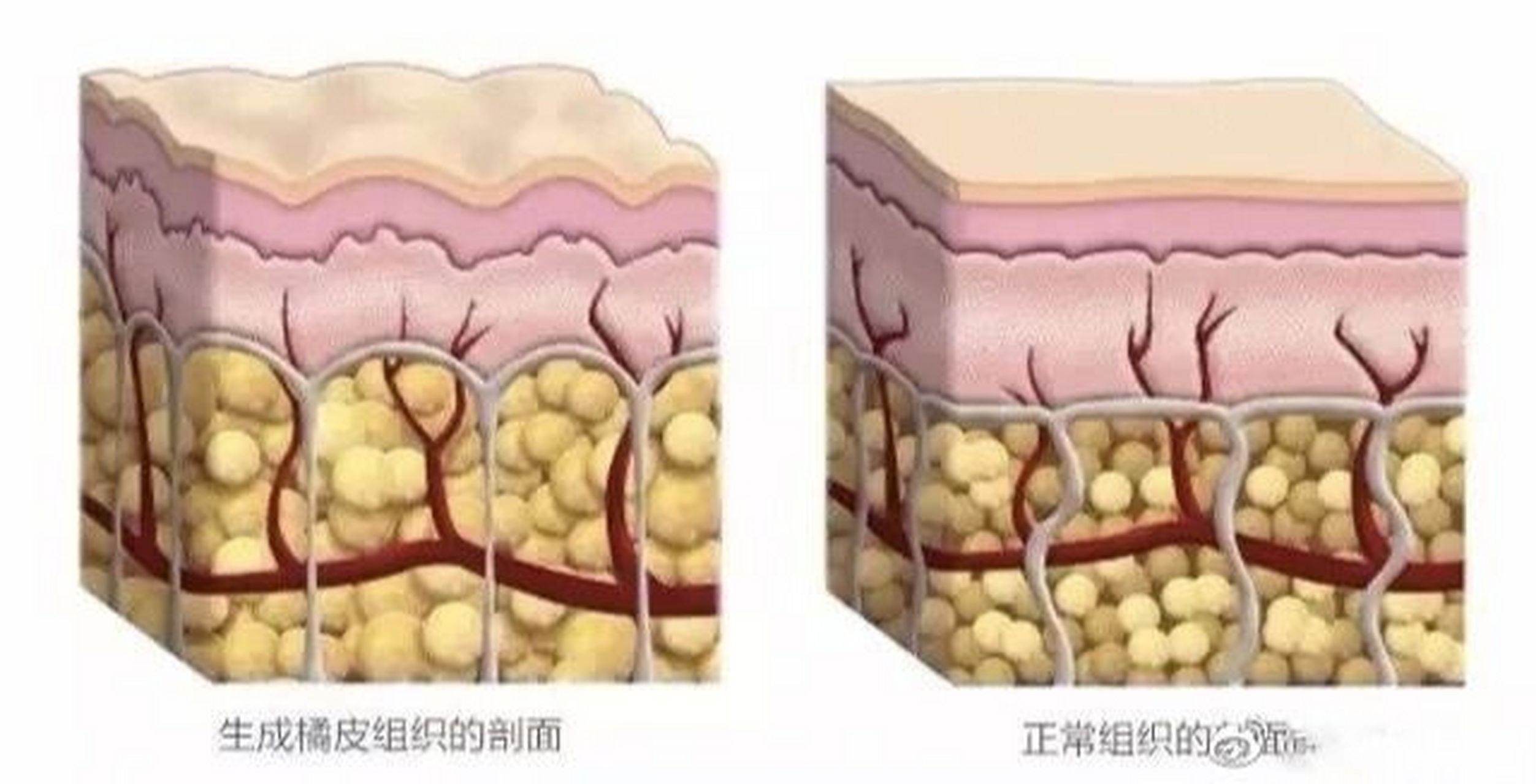 荷尔蒙:荷尔蒙是橘皮组织出现和发展的重要因素,此外雌性激素,胰岛素