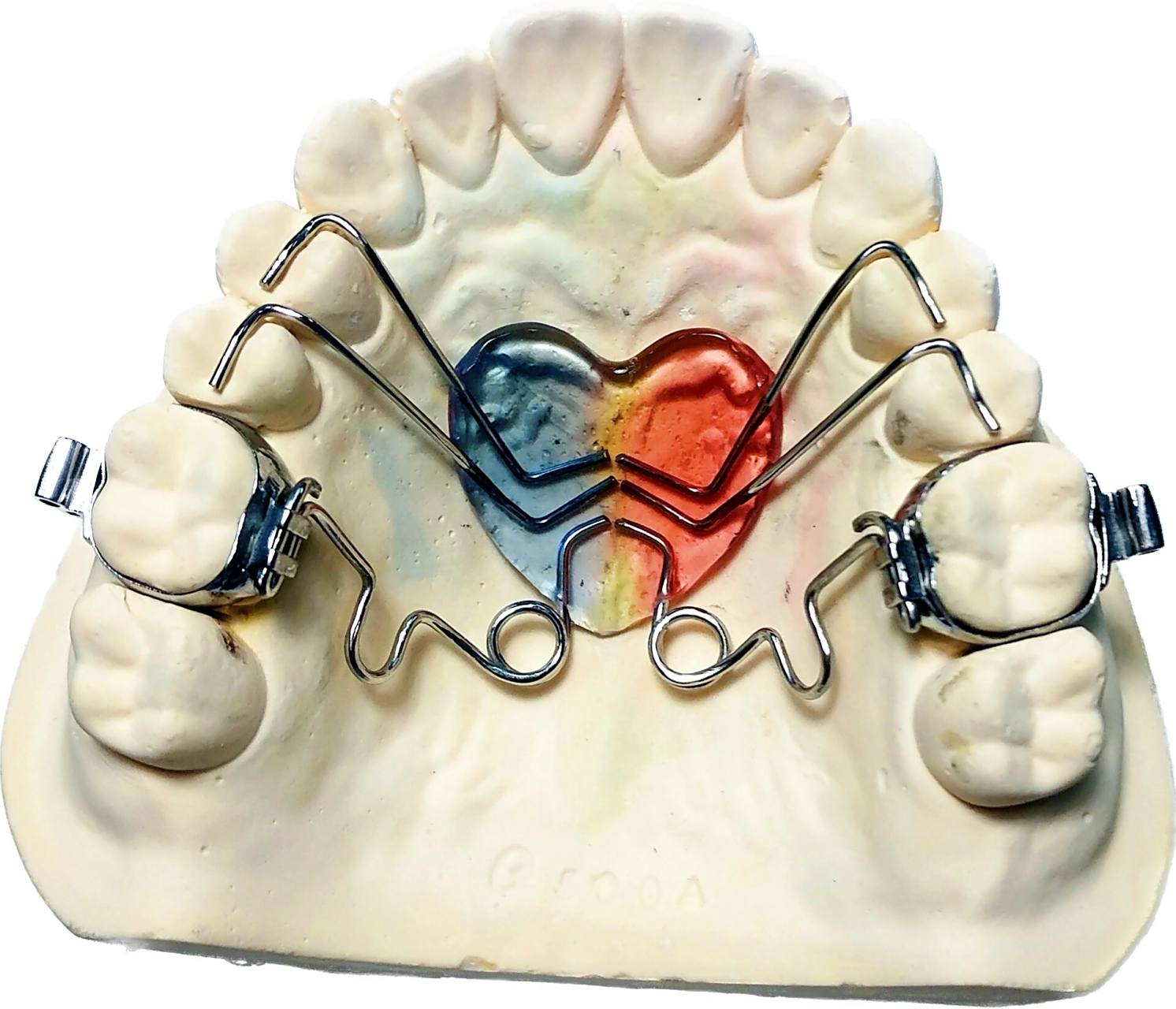 矫治器 钟摆矫治器 pendulum 矫治器加扩弓器 钟摆式矫治器,于1992年