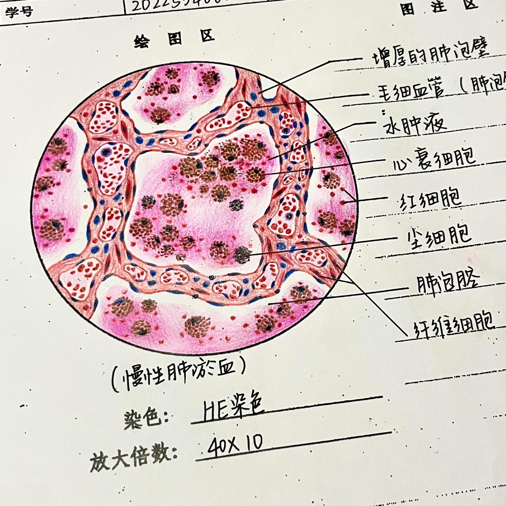 肺淤血病理作业图图片