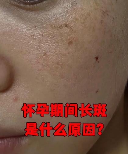 怀孕期间长斑是什么原因?