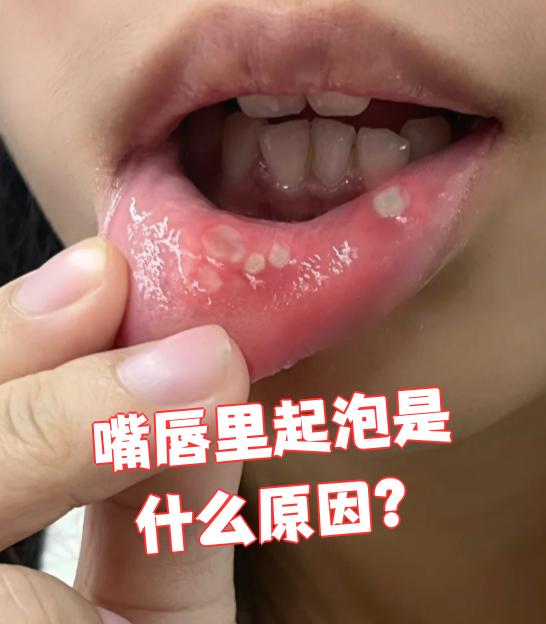 吃蜂蜜嘴唇起泡是什么原因(吃了蜂蜜嘴巴肿起来是什么原因)