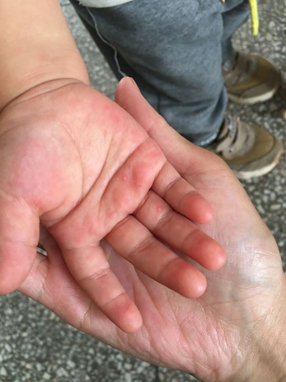 吃不懂手足口症状的亏 前两天中午突然发现儿手上有一个泡,没太在意