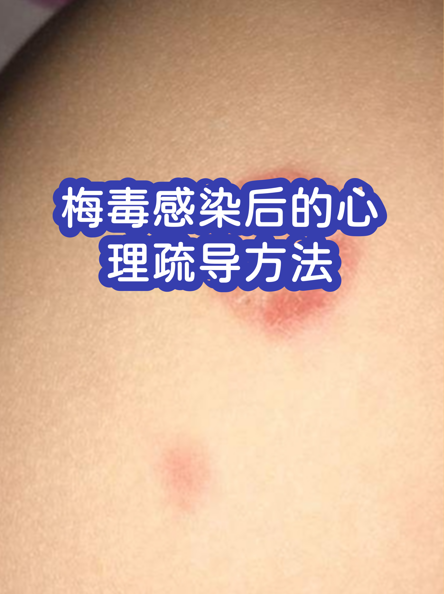  疫情以后的心理疏导有哪些内容(疫情以后的心理疏导有哪些内容和途径)