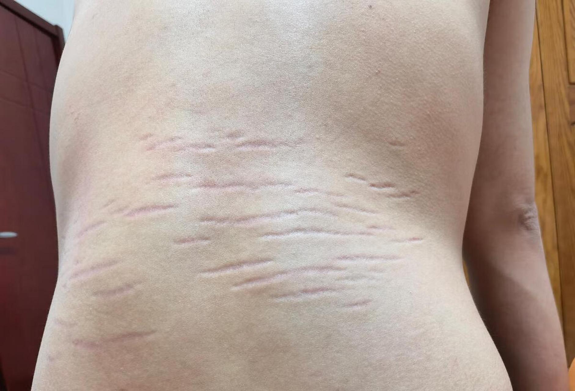 膨胀纹也叫萎缩纹.#妊娠纹