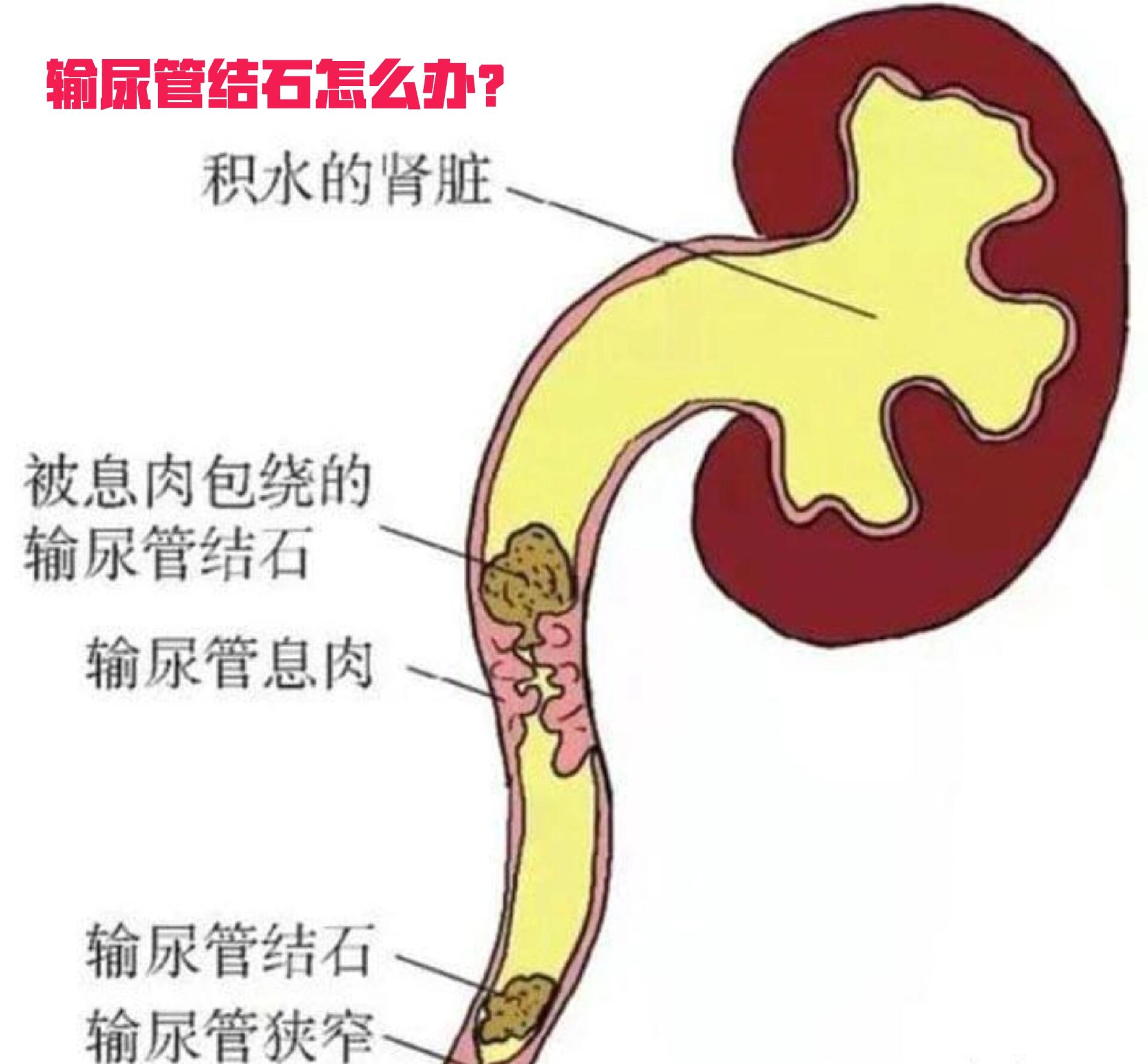 输尿管结石位置图图片