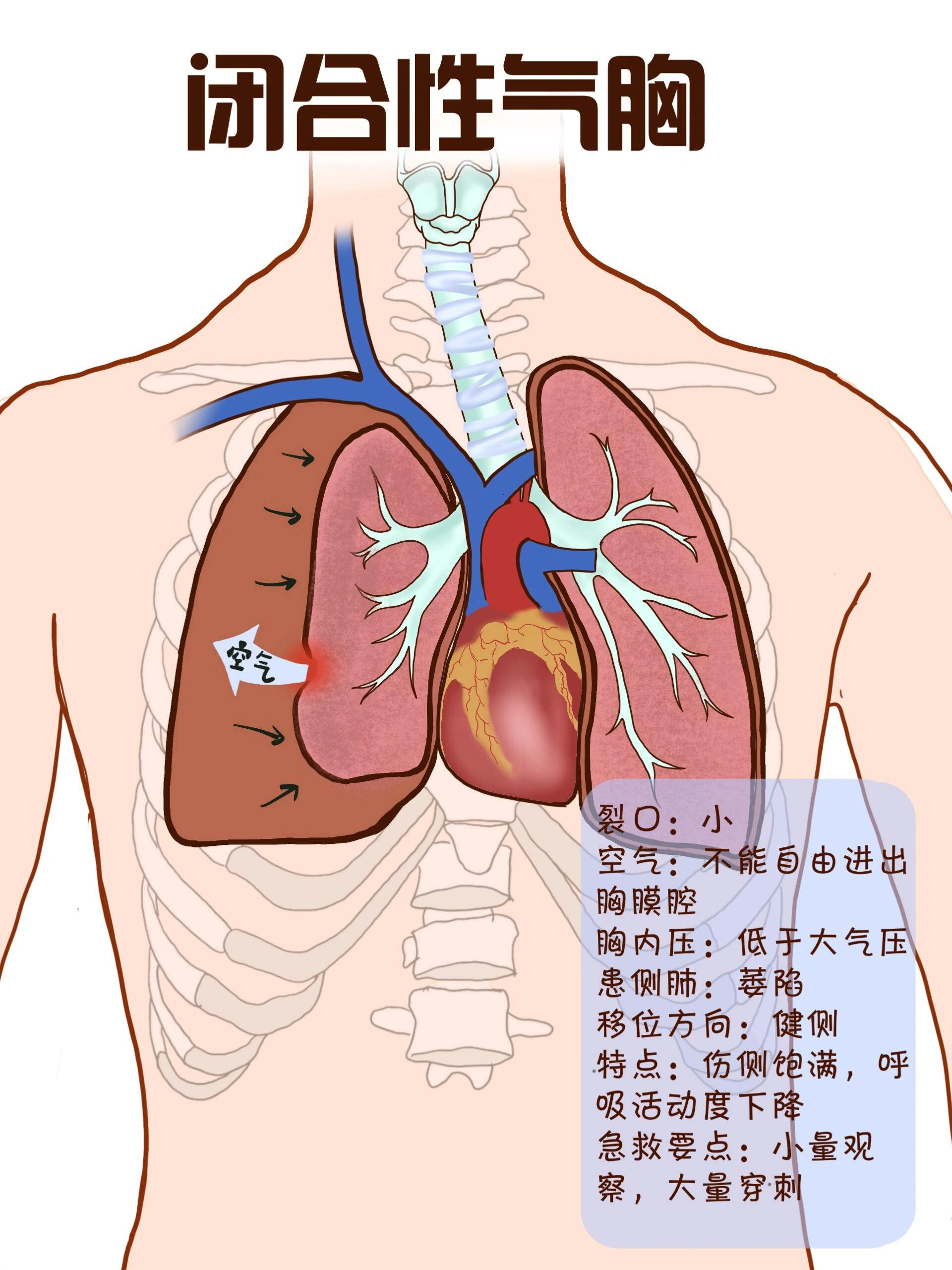 区分三种气胸 胸腔 闭式引流