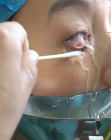 如果发现眼睛里长了眼线虫(结膜吸吮线虫),别担心,治疗方法很明确