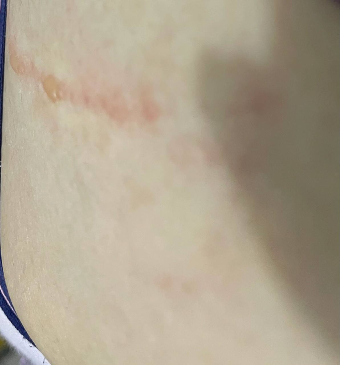 暖宝宝低温烫伤,切勿贴肤 腹部发现俩排水泡,竟然是怀疑衣服太久没穿