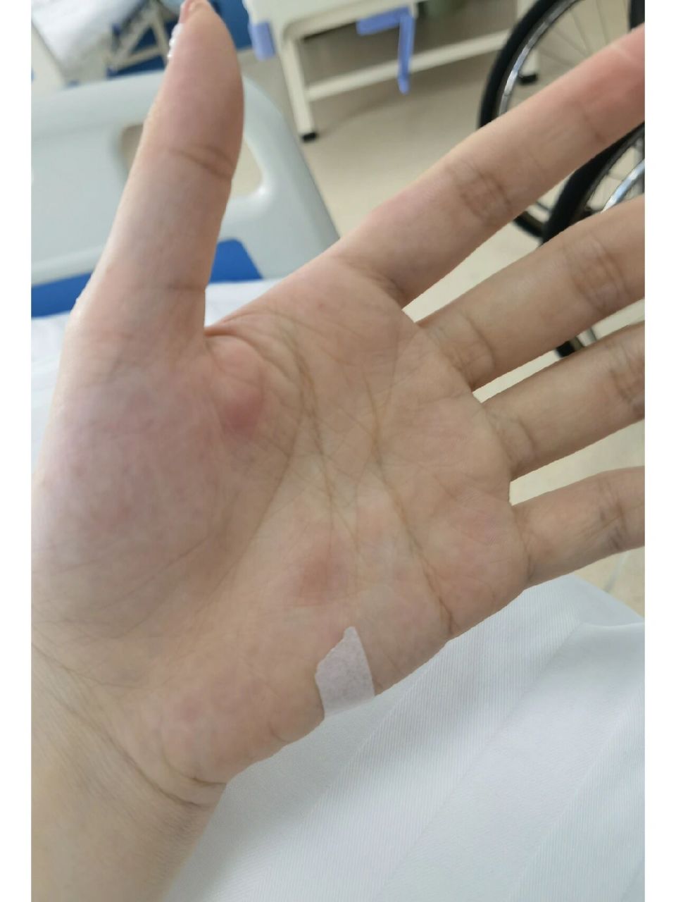 蚊子咬手心想必不用我描述多痛苦了吧 作为一个学果树,果园做调查必不