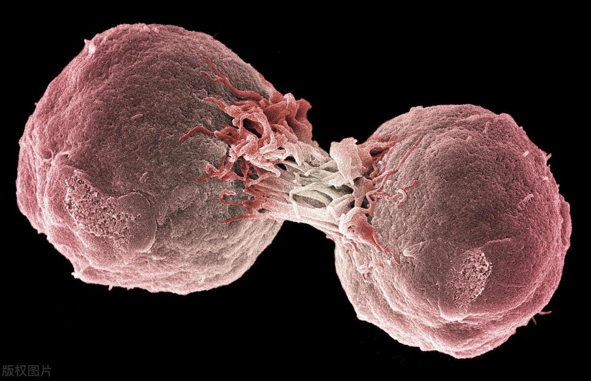 淋巴癌是一种危害很大的恶性肿瘤,其早期症状非常隐蔽,包括淋巴结肿大