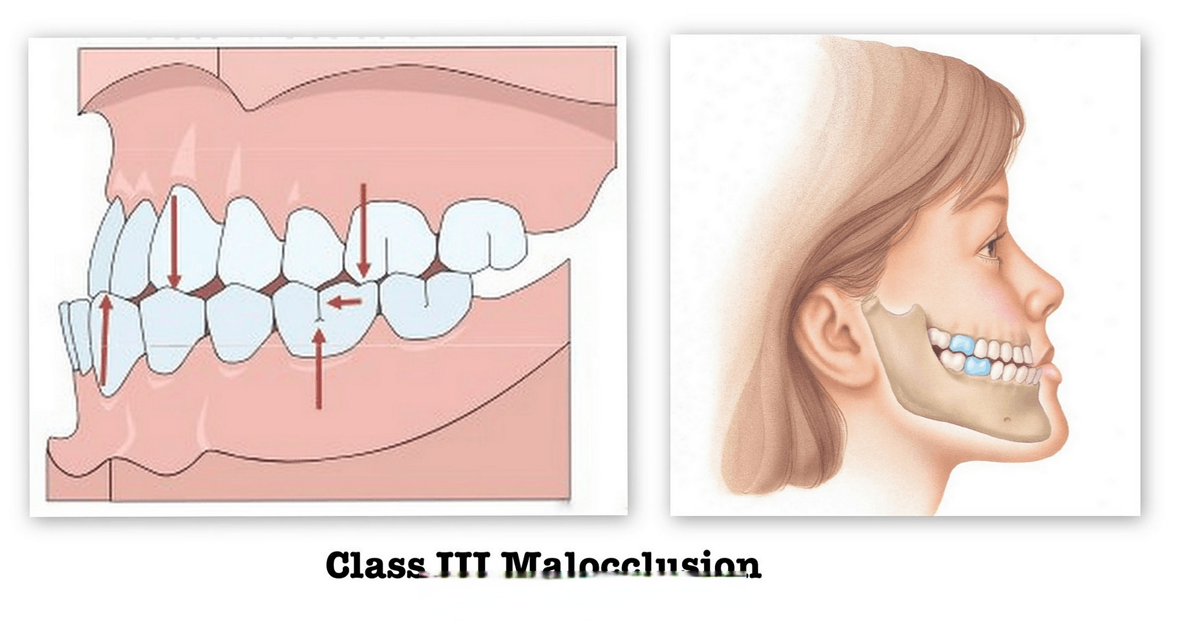 青年美医进阶计划# 小朋友已经有明显反颌(地包天),长大怎么办?