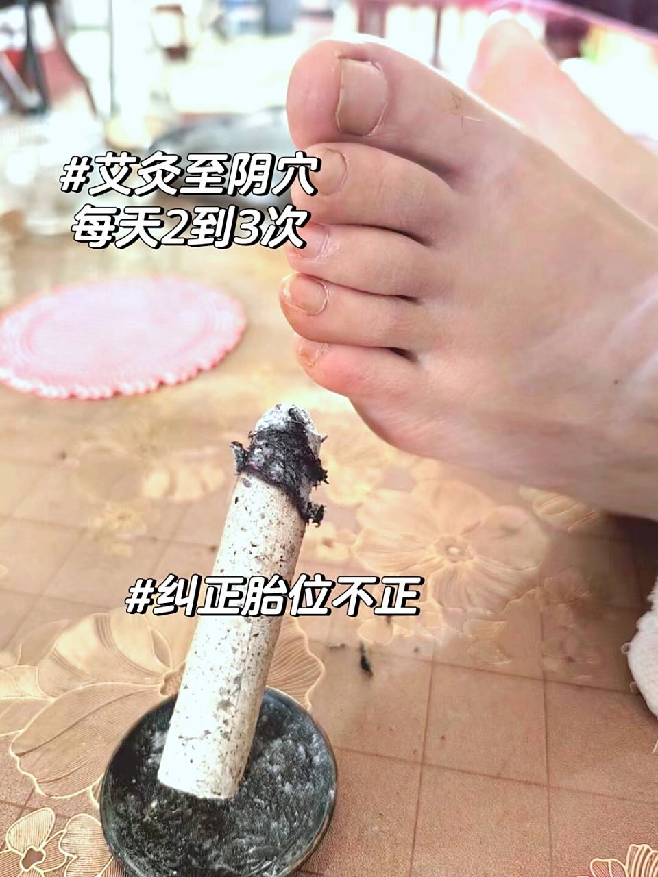 41岁三胎孕晚期艾灸至阴穴纠正胎位不正 这段时间一直也没有在小红书