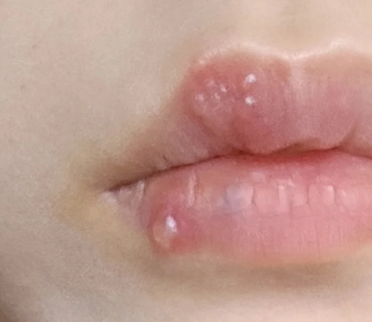 嘴唇起泡发痒最常见的原因是单纯疱疹或慢性唇炎