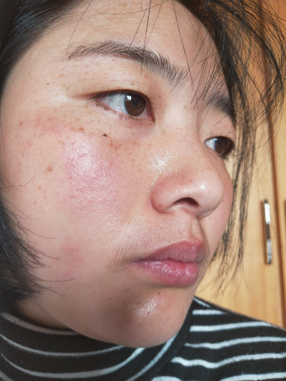 翻翻以前激素皮炎的照片真可怕 今天突然翻到了去年激素脸的照片!