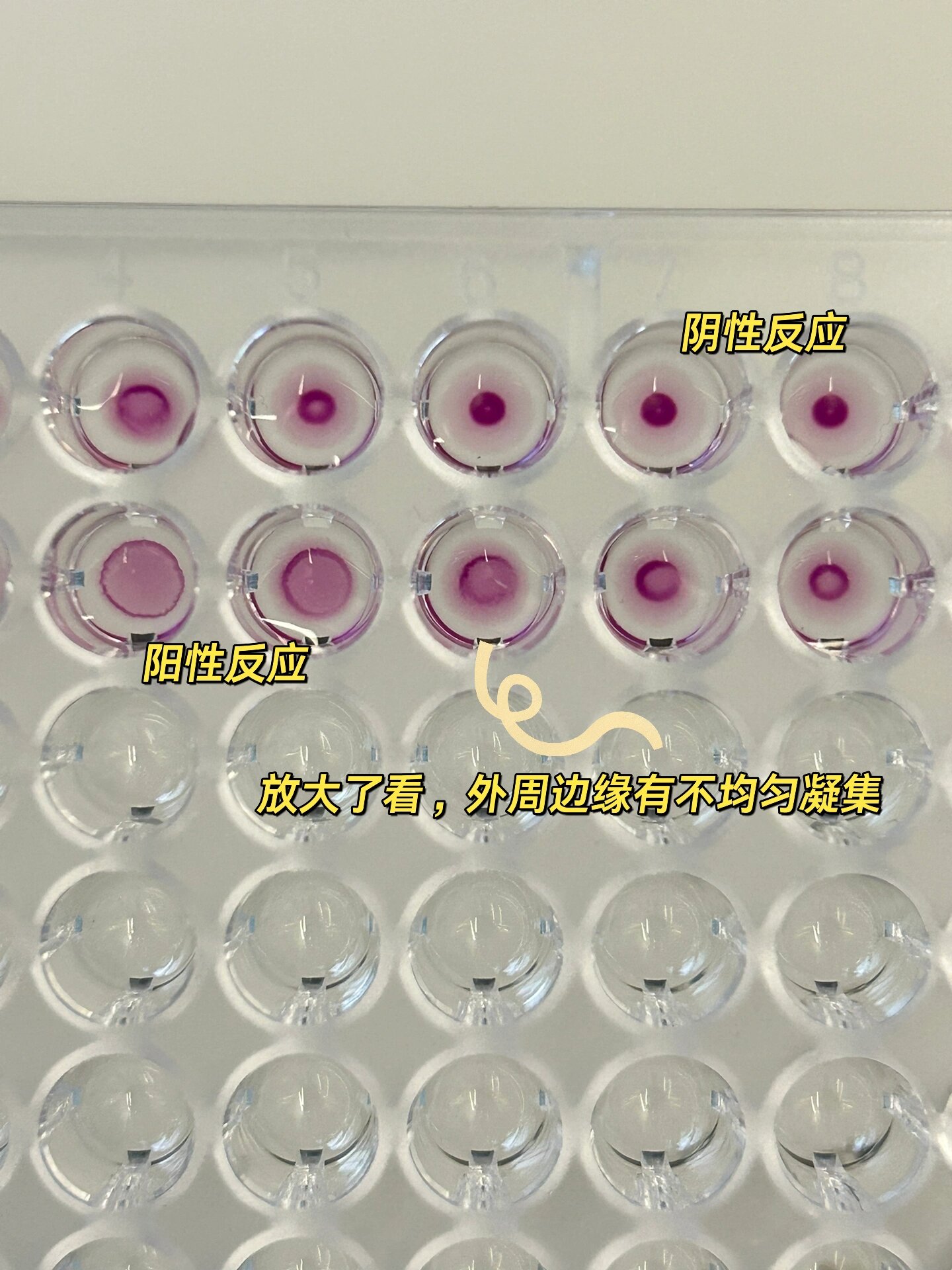 检验人 | tppa判定和假阳性 隐性梅毒诊断依据为: (1)符合临床流行病