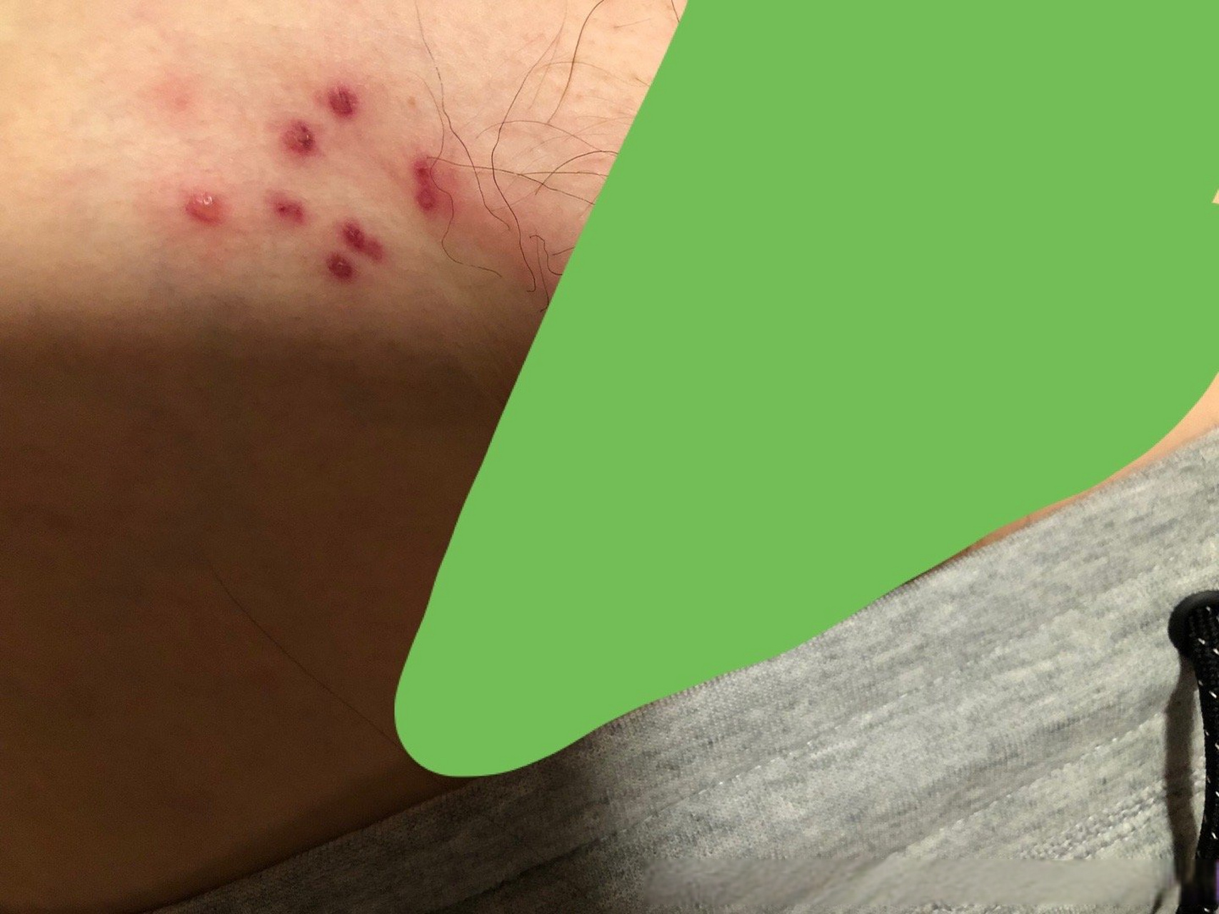 大概五天前腹股沟突然起了10来个红疙瘩.