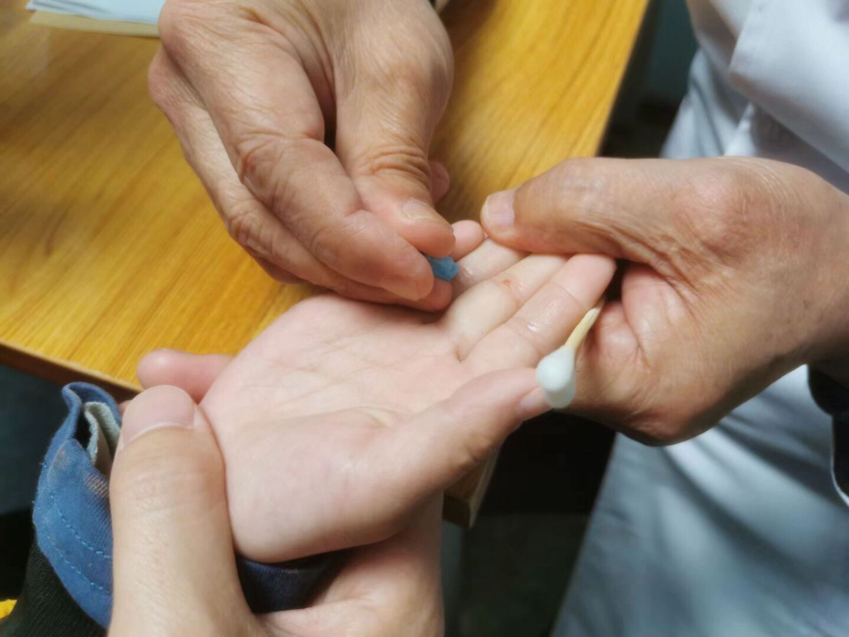 中医传统扎疳积,大部分小孩都有脾胃 积食 什么是疳积71 71 71