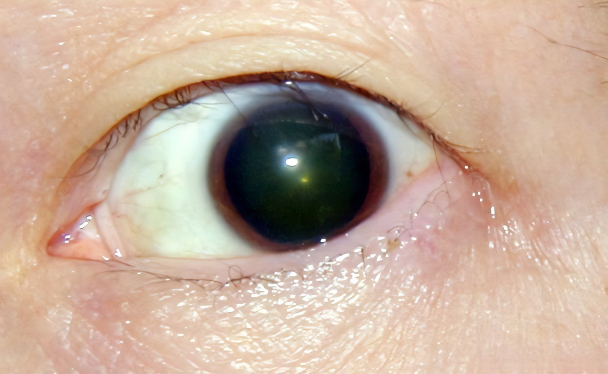 散瞳其实并不是目的,之所以散瞳,是为了查出准确的度数.