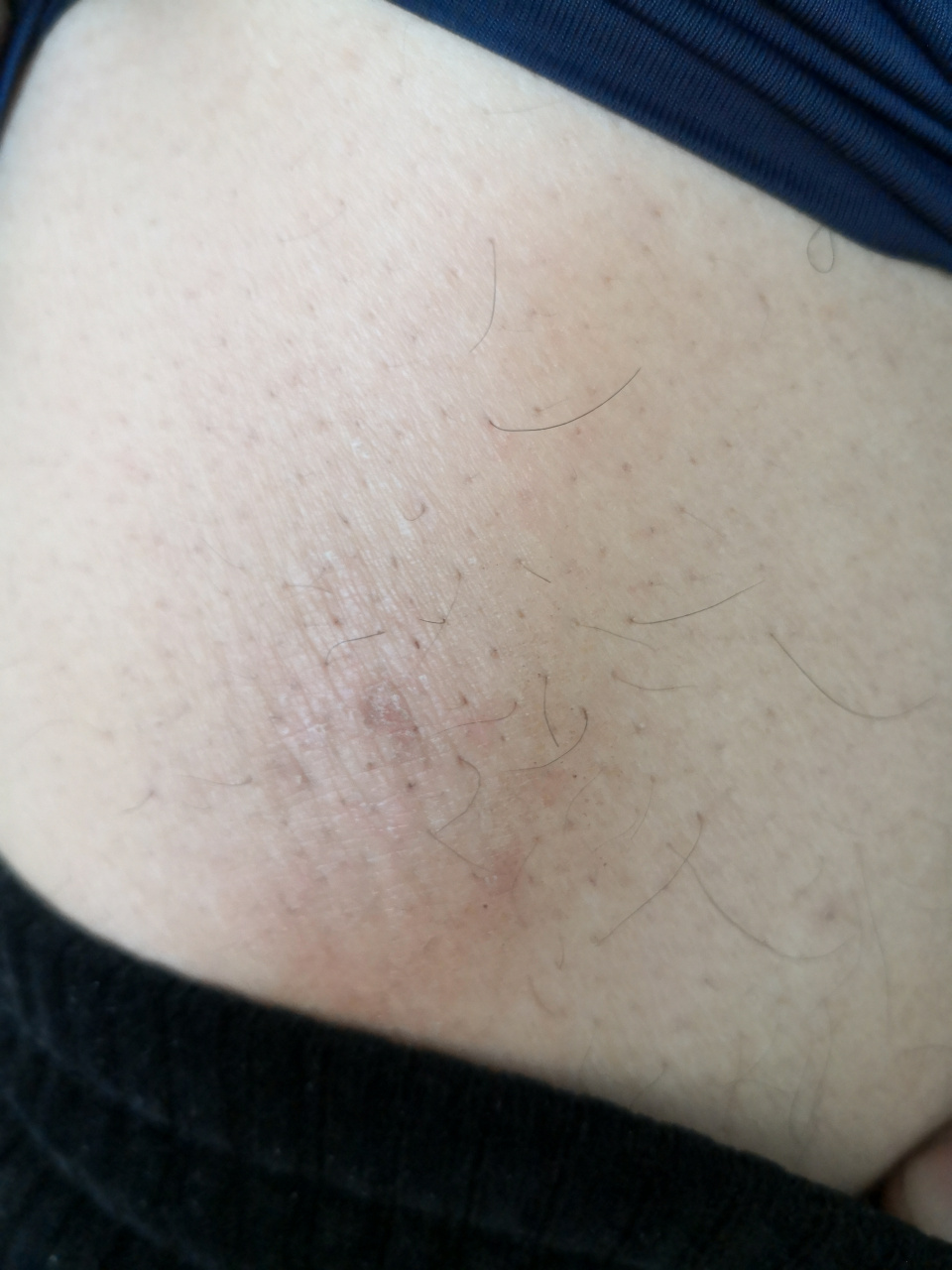 右侧大腿前侧的苔藓样变.皮炎症状.#皮炎