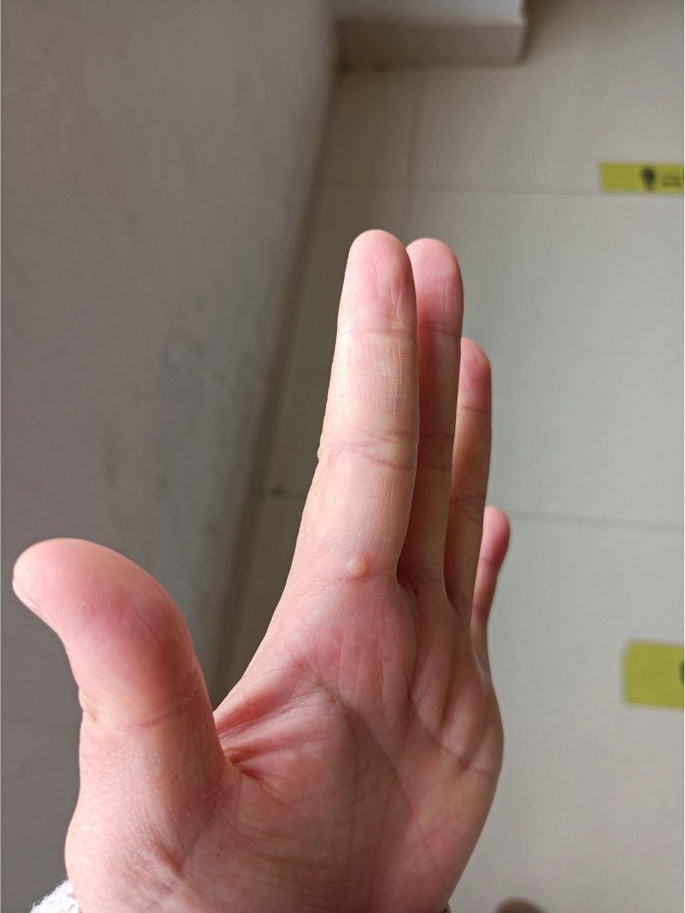 手指长瘊子症状图片图片