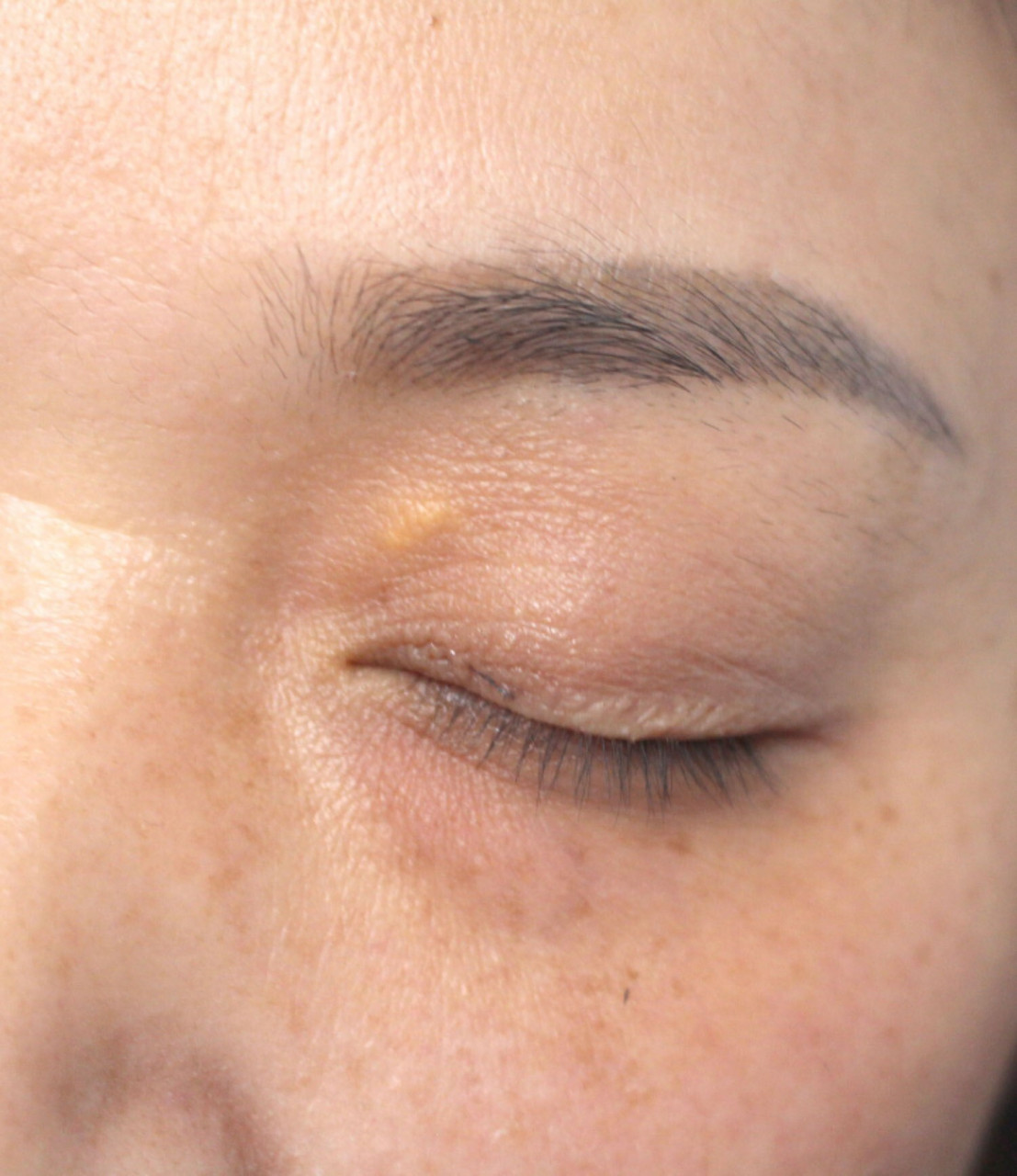 睑黄瘤完美消失