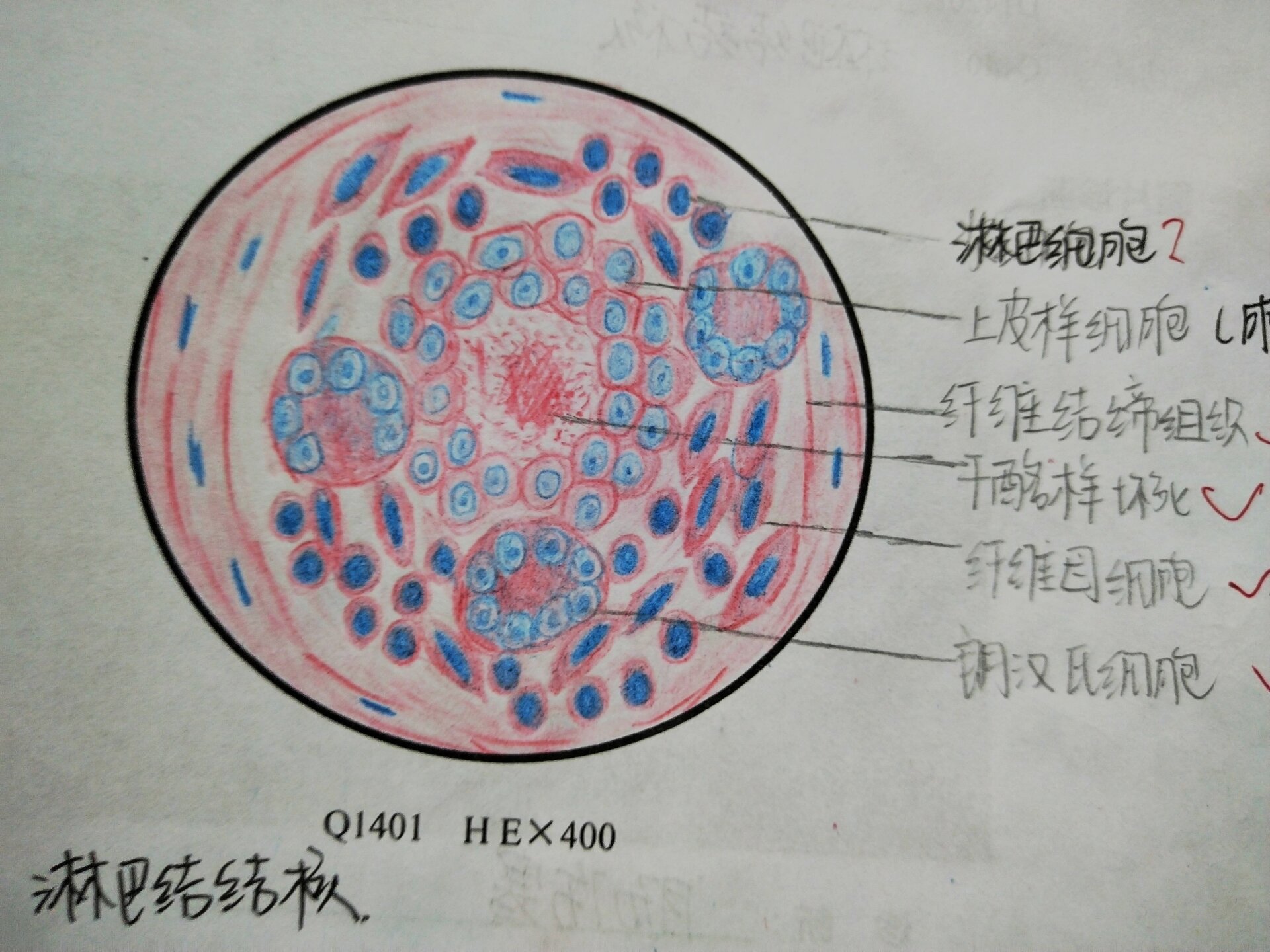 淋巴结结核手绘图    图片上是淋巴结结核 400倍镜下描述: 部分淋巴结