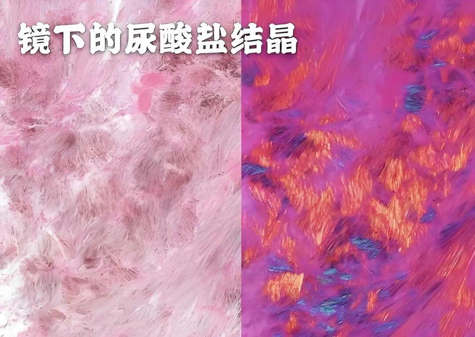 尿酸结晶怎么消除图片