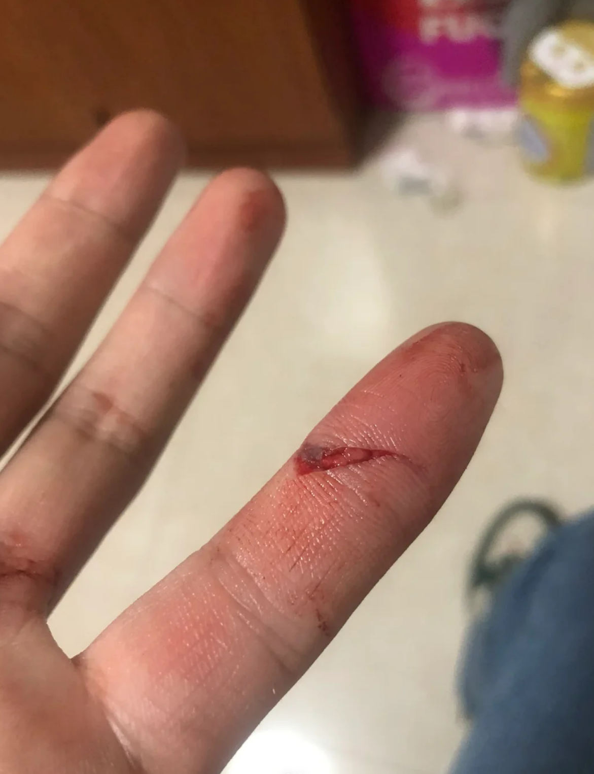 如果是小动脉损伤,别看伤口小,但出血会比较多