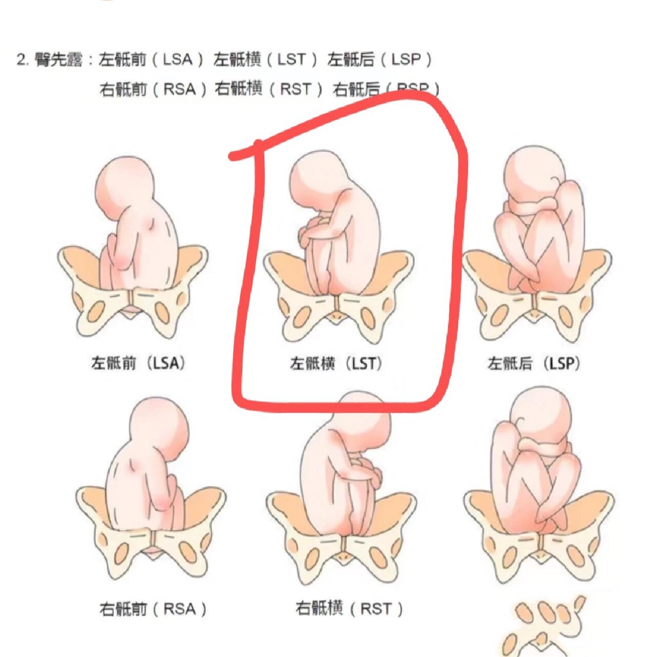 22周大排畸臀位lst 胎动一直在下面,在毛毛那块,崽子一直用脚踢踢踢