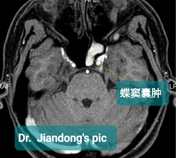 蝶窦囊肿图片图片