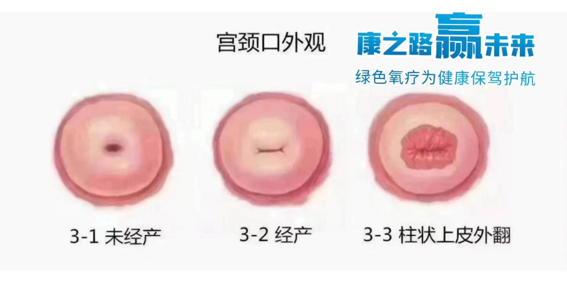 产道 拓宽图片