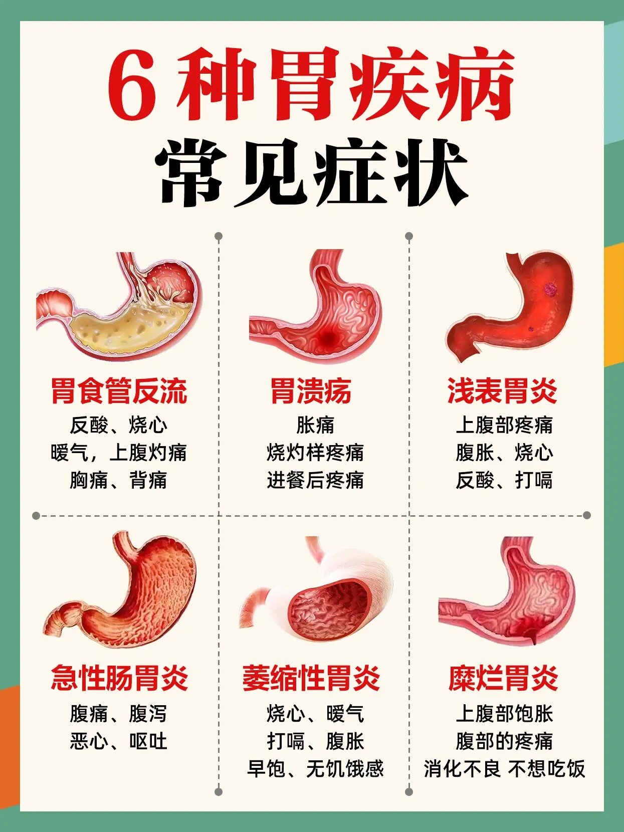 【胃溃疡】 胃溃疡的典型症状是上腹部或剑突下疼,疼痛的性质可以是钝