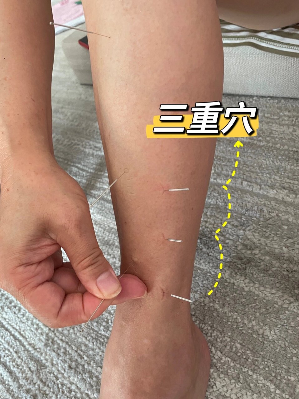 【董氏针灸·网球肘】 肾关四肢 侧三侧下三 三重穴