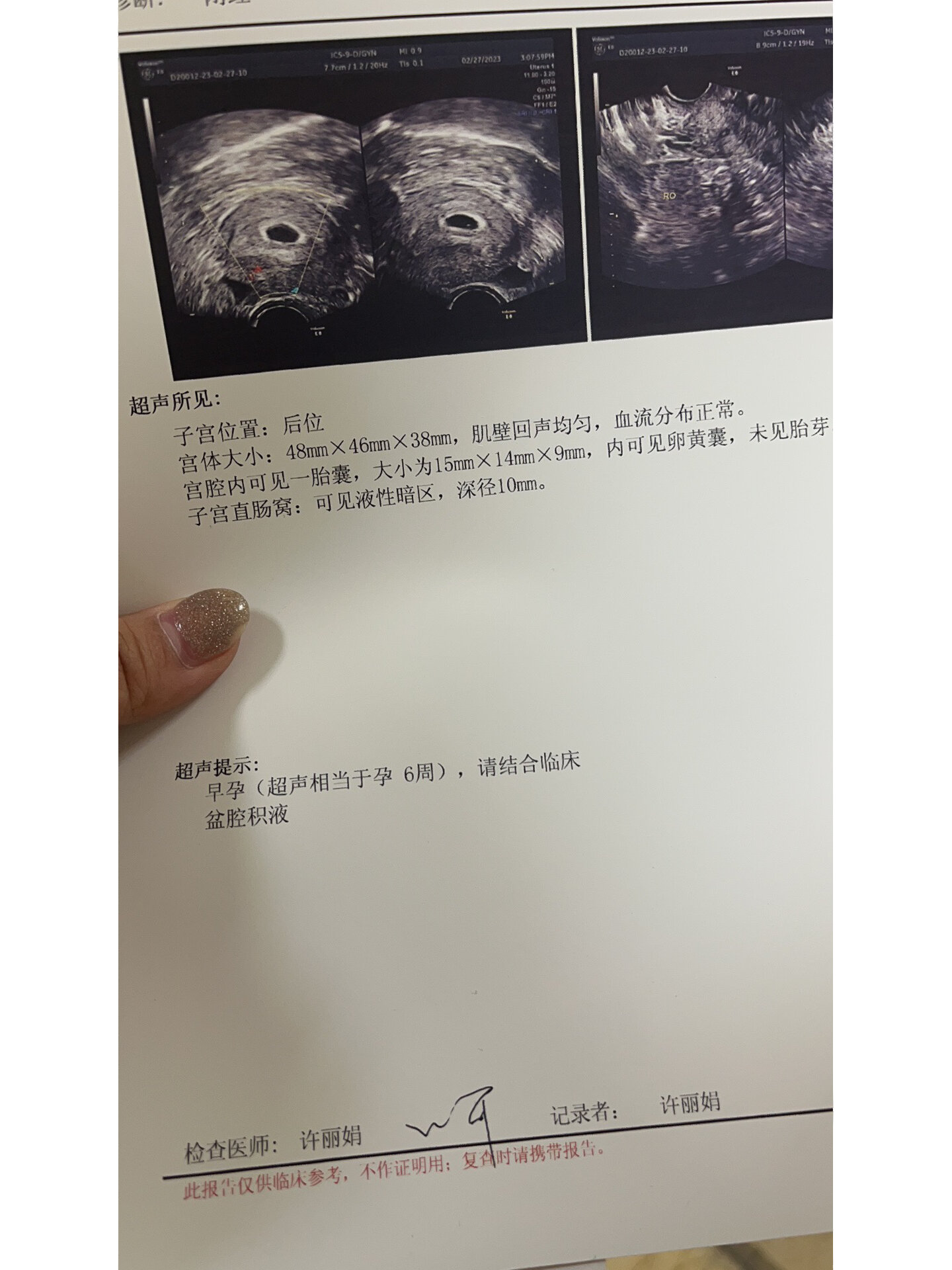 出现了卵黄囊,还没有见胎心胎芽 隔了一个礼拜,怀着紧张的心来做了