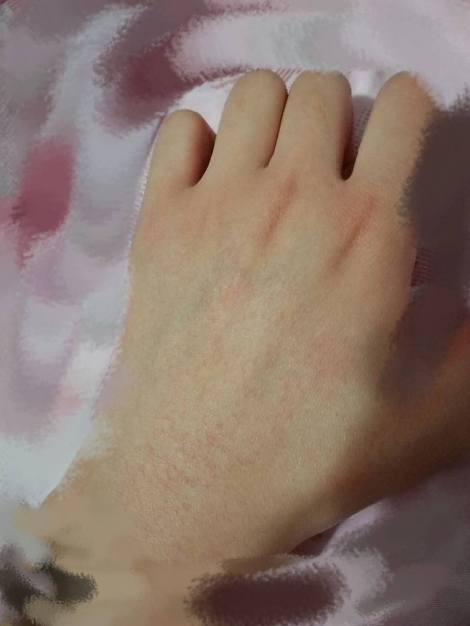 手背发红 我想知道我手是怎么了 有人说冻疮 有人说洗完手吹凉风了