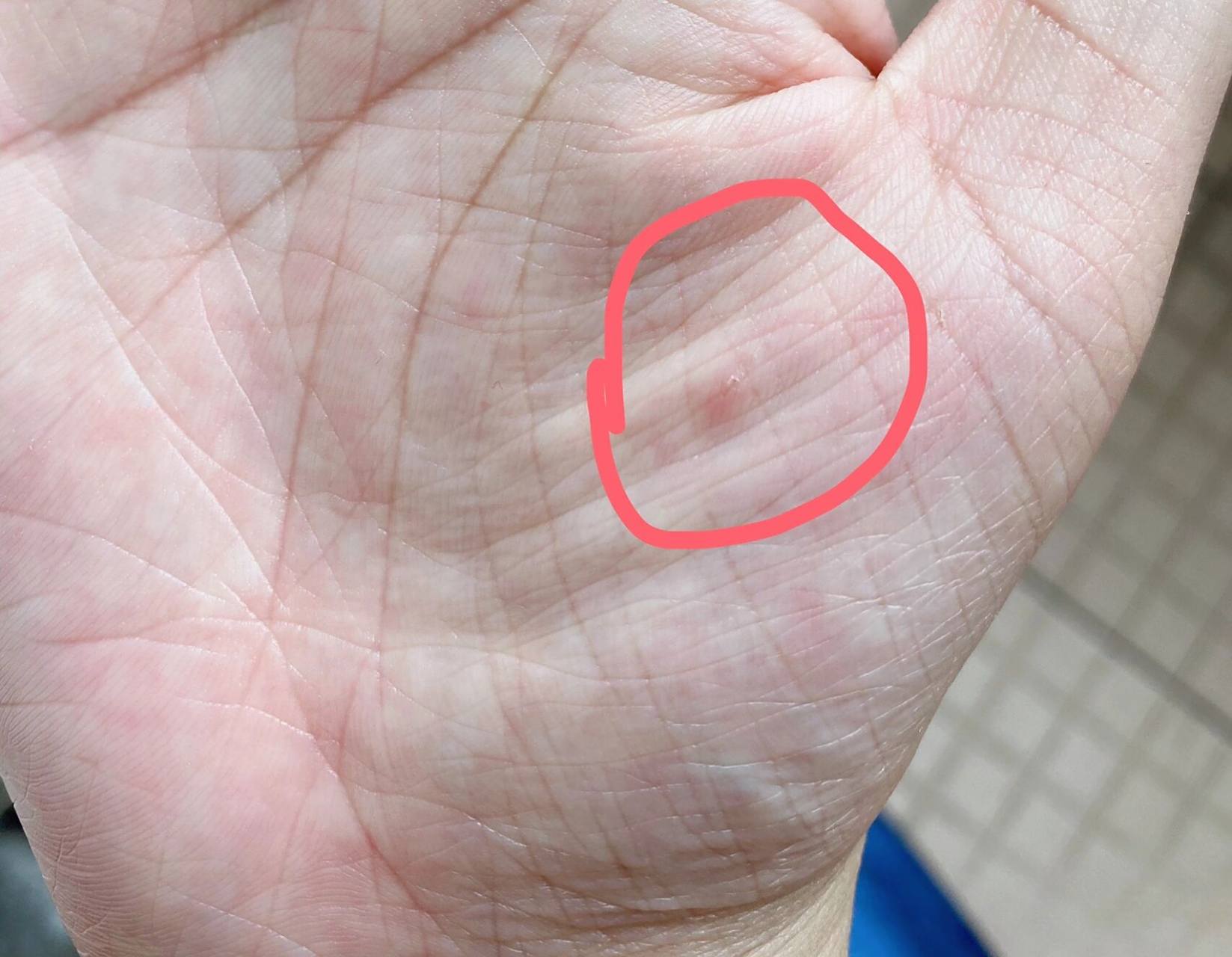 小刺扎到肉里 弄床板的时候不小心,刺扎到肉里了