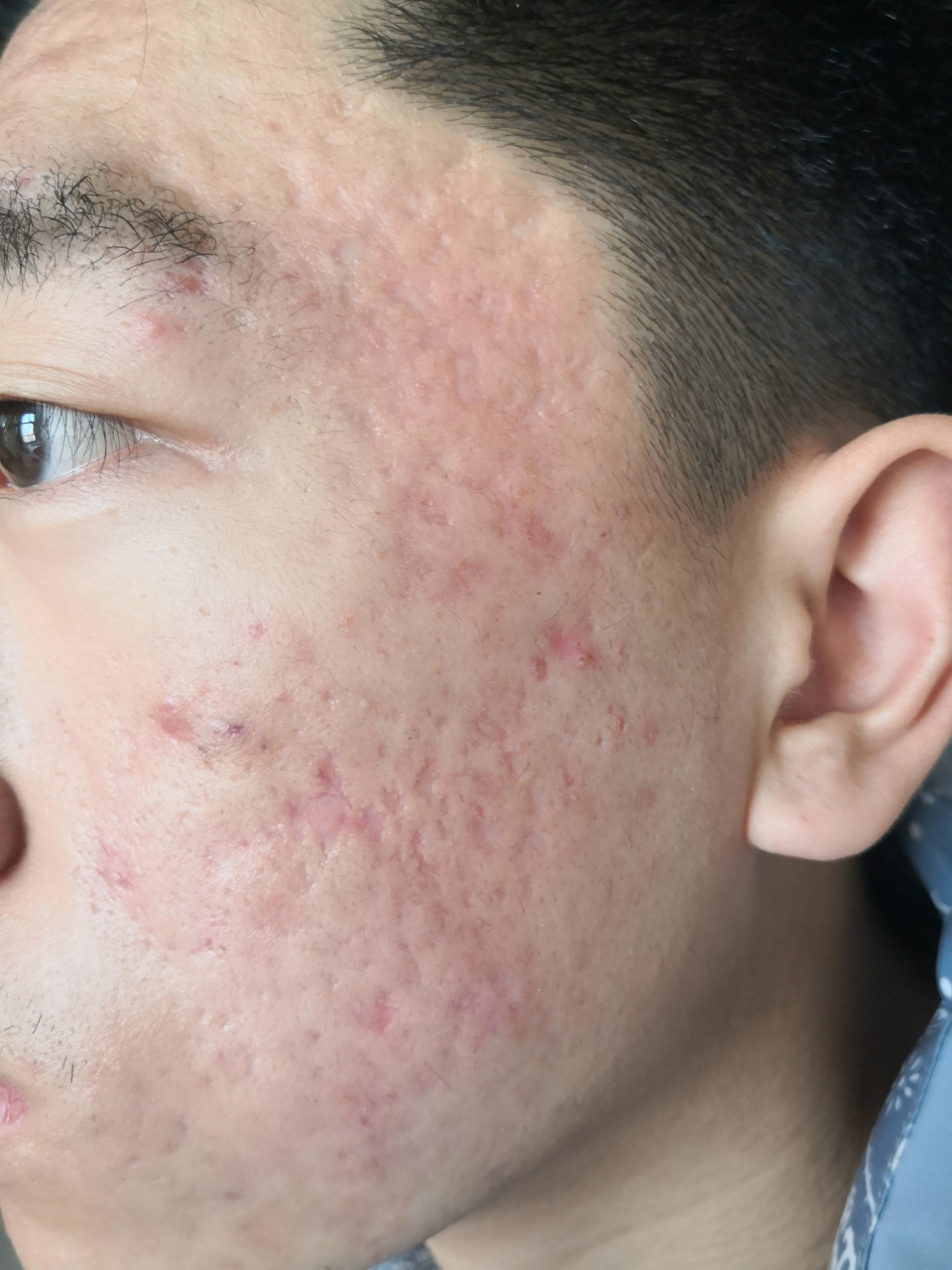 痘坑痘印##痤疮##疤痕