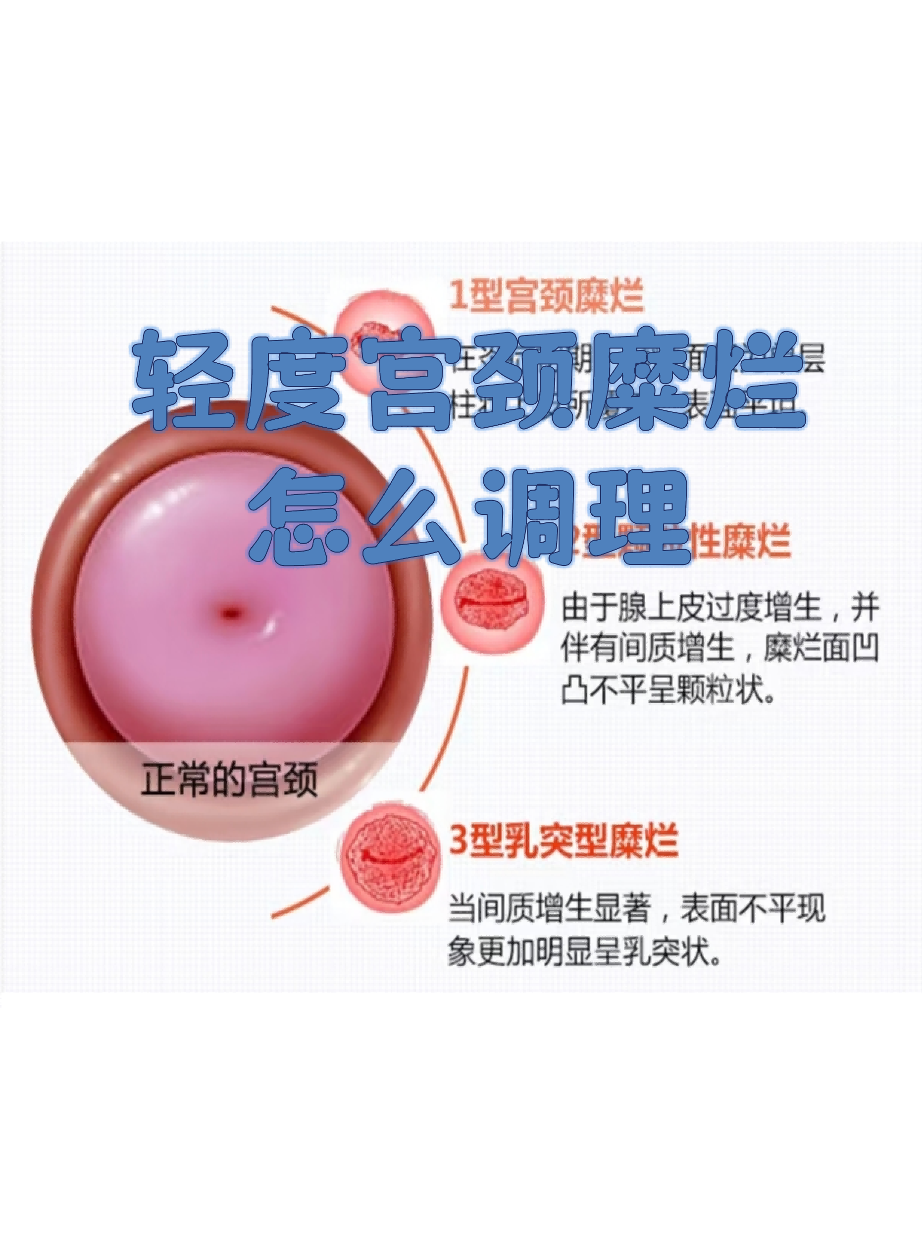 轻度宫颈糜烂怎么调理