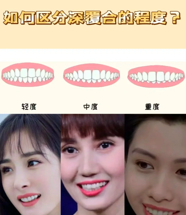 但其实牙齿深覆合也是一种牙齿畸形情况,时间长了会导致牙齿磨损严重