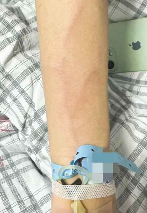 手臂靠近腋窝处有血痕可能和抓伤,膨胀纹,静脉炎这些情况有关