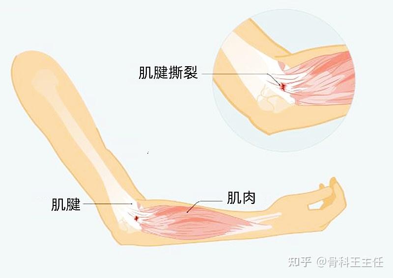 关节疼痛是肌腱炎滑囊炎还是拉伤不要再分不清了
